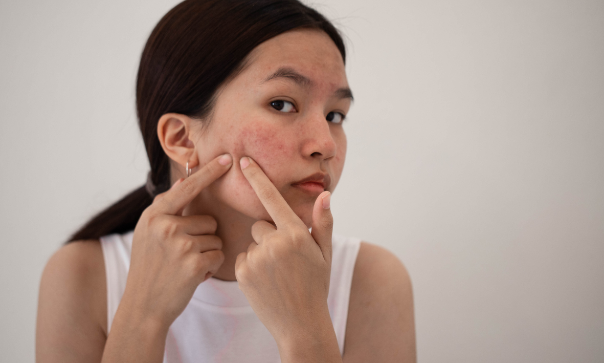 Hormonelle Akne bekämpfen: Ursachen, Tipps und Hausmittel